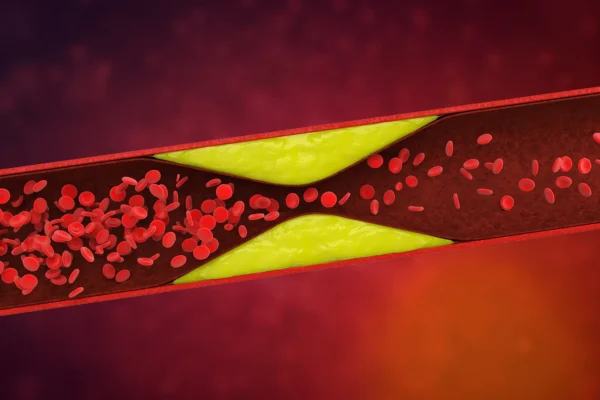 Hidden in your dna: The mutation combo that raises clot risk by 180%