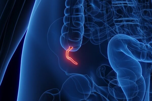 Appendix Cancer Has Quadrupled in Millennials
