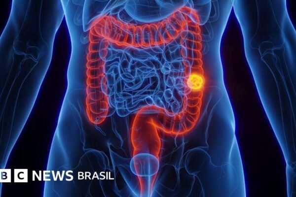 Preta Gil: Por que câncer colorretal cresce tanto entre pessoas de até 50 anos